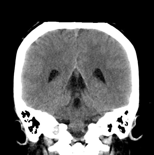 File:Atretic encephalocoele with inferior vermis hypoplasia (Radiopaedia 30443-31107 Coronal non-contrast 26).jpg