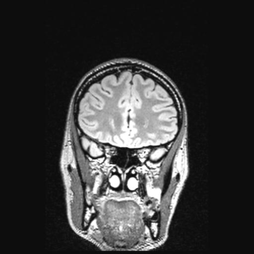 Atretic encephalocoele with inferior vermis hypoplasia (Radiopaedia 30443-31108 Coronal FLAIR 134).jpg