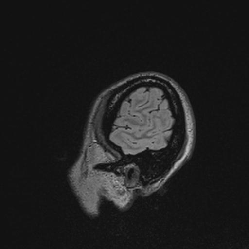 Atretic encephalocoele with inferior vermis hypoplasia (Radiopaedia 30443-31108 Sagittal FLAIR 139).jpg