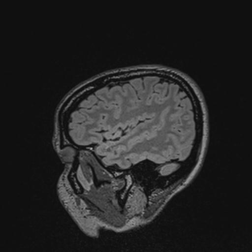 Atretic encephalocoele with inferior vermis hypoplasia (Radiopaedia 30443-31108 Sagittal FLAIR 39).jpg