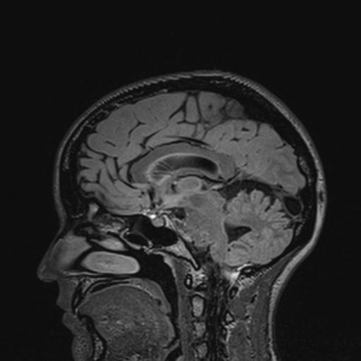 Atretic encephalocoele with inferior vermis hypoplasia (Radiopaedia 30443-31108 Sagittal FLAIR 79).jpg