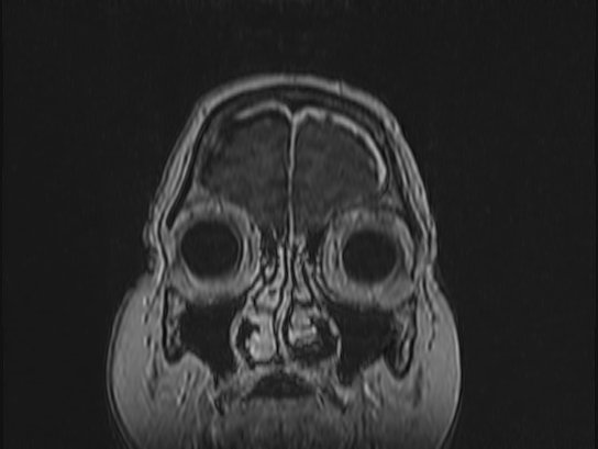 Atypical meningioma (Radiopaedia 62985-71406 Coronal T1 C+ 9).jpg
