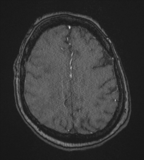 Atypical meningioma (WHO Grade II) (Radiopaedia 54742-60981 Axial MRA 72).png