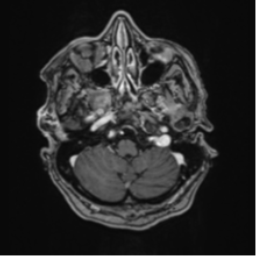 Atypical meningioma (WHO Grade II) (Radiopaedia 54742-60981 Axial T1 C+ 12).png