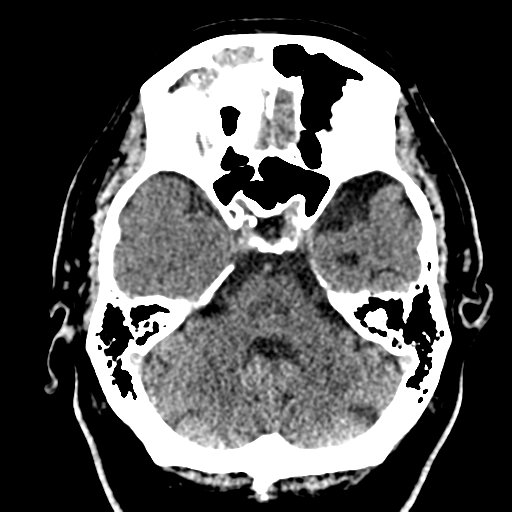 File:Atypical meningioma (WHO grade II) with brain invasion (Radiopaedia 57767-64728 Axial non-contrast 10).png