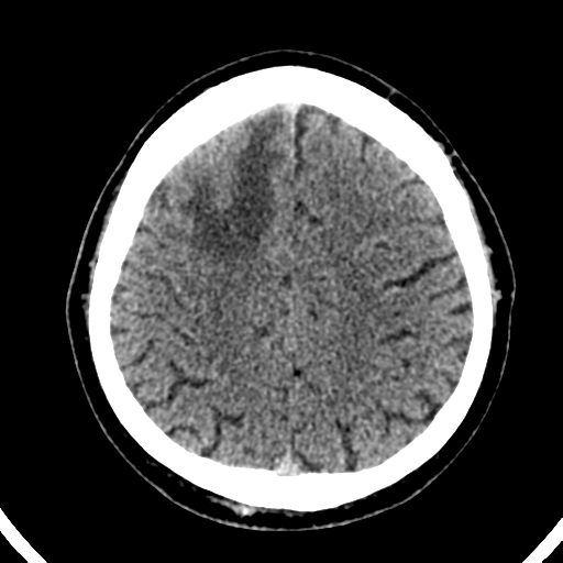 File:Atypical meningioma (WHO grade II) with brain invasion (Radiopaedia 57767-64728 Axial non-contrast 33).png