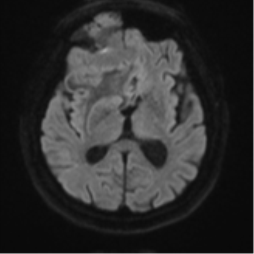File:Atypical meningioma (WHO grade II) with brain invasion (Radiopaedia 57767-64729 Axial DWI 45).png