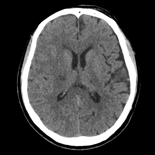 File:Atypical meningioma (WHO grade II) with osseous invasion (Radiopaedia 53654-59715 Axial non-contrast 30).png