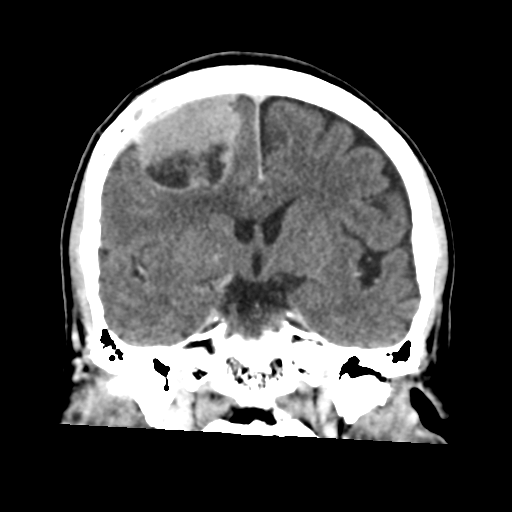 Atypical meningioma (WHO grade II) with osseous invasion (Radiopaedia 53654-59715 Coronal C+ delayed 29).png