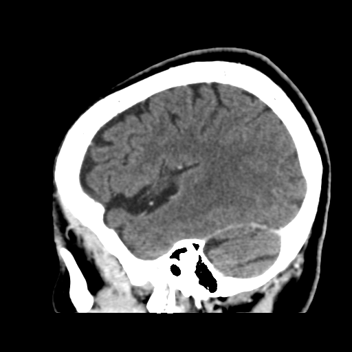 Atypical meningioma (WHO grade II) with osseous invasion (Radiopaedia 53654-59715 G 42).png
