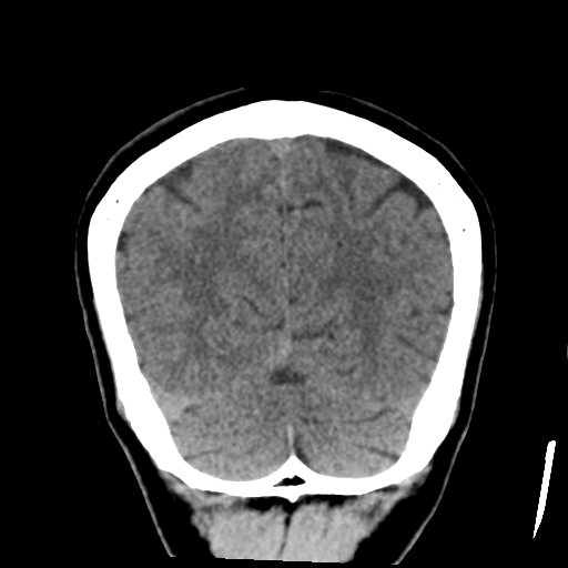Atypical meningioma with skull invasion (Radiopaedia 34357-35649 Coronal non-contrast 50).png