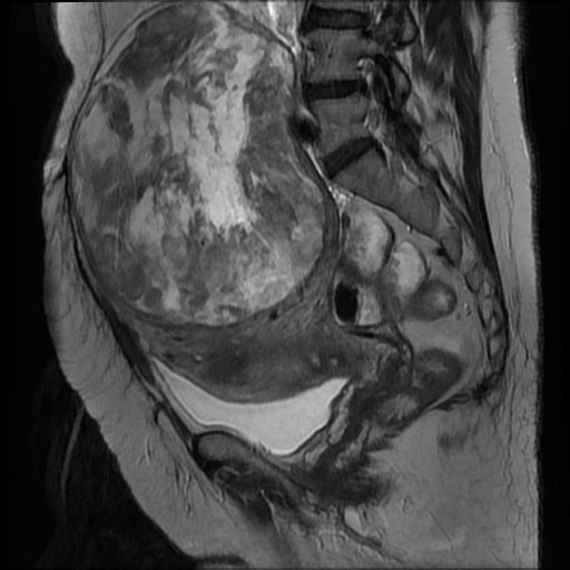 File:Atypical retroperitoneal lymphocoeles with large leiomyoma of uterus (Radiopaedia 32084-33027 Sagittal T2 14).jpg