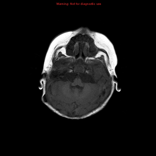 File:Atypical teratoid rhabdoid tumor (Radiopaedia 10712-11183 Axial T1 14).jpg