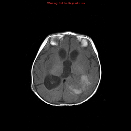 File:Atypical teratoid rhabdoid tumor (Radiopaedia 10712-11183 Axial T1 9).jpg