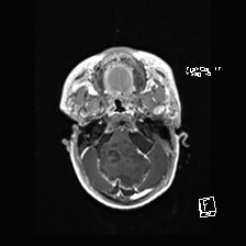 Atypical teratoid rhabdoid tumor (prenatal US and neonatal MRI) (Radiopaedia 59091-66388 Axial T1 C+ 13).jpg