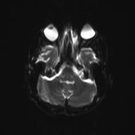 Autoimmune limbic encephalitis (Radiopaedia 30363-31005 Axial B0 and DWI 9).jpg