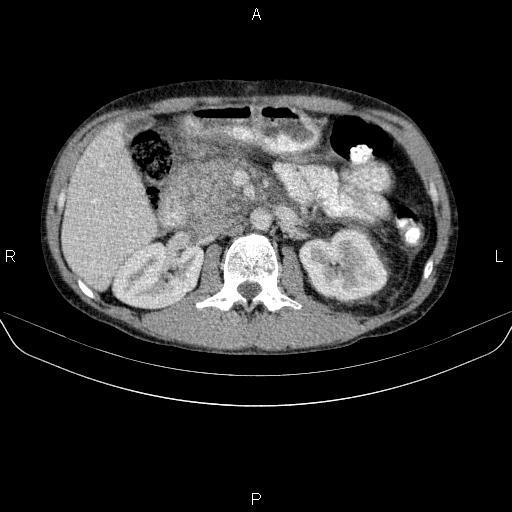 File:Autoimmune pancreatitis (Radiopaedia 84925-100431 B 23).jpg