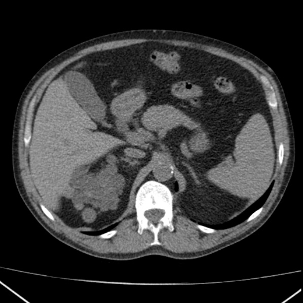 File:Autosomal dominant polycystic kidney disease (Radiopaedia 36539-38101 Axial non-contrast 24).jpg