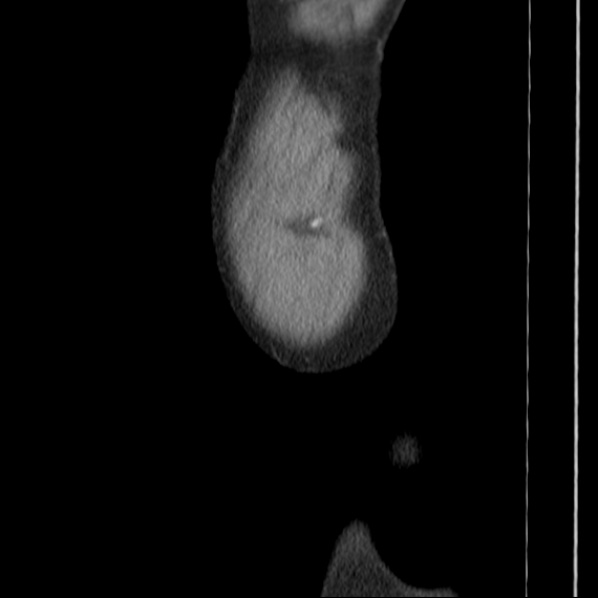 Autosomal dominant polycystic kidney disease (Radiopaedia 36539-38101 D 82).jpg