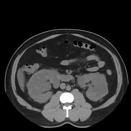 Autosomal dominant polycystic kidney disease (Radiopaedia 50259-55612 Axial non-contrast 41).jpg