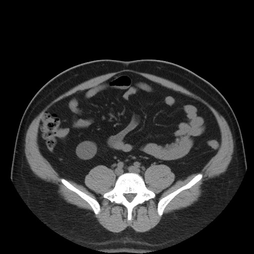 Autosomal dominant polycystic kidney disease (Radiopaedia 50259-55612 Axial non-contrast 57).jpg