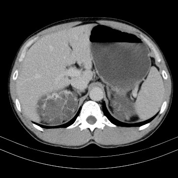 Autosomal dominant polycystic kidney disease (Radiopaedia 66349-75582 B 21).jpg