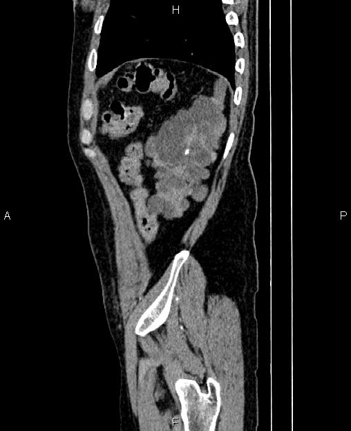 Autosomal dominant polycystic kidney disease (Radiopaedia 87830-104287 C 82).jpg