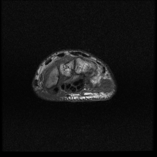 File:Avascular necrosis - scaphoid non-union (Radiopaedia 63457-72065 Axial T1 8).jpg