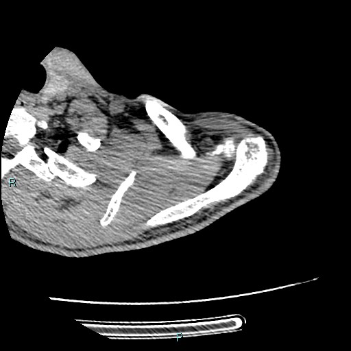 Avascular necrosis after fracture dislocations of the proximal humerus (Radiopaedia 88078-104655 D 28).jpg