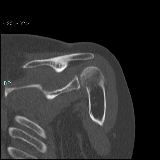 Avascular necrosis of the shoulder - Cruess stage I (Radiopaedia 77674-89887 Coronal bone window 61).jpg
