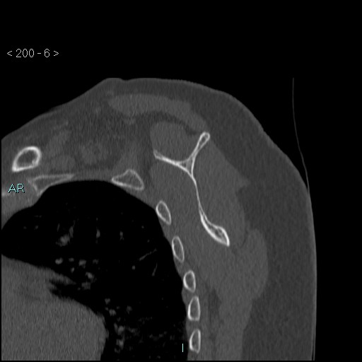 Avascular necrosis of the shoulder - Cruess stage I (Radiopaedia 77674-89887 Sagittal bone window 5).jpg