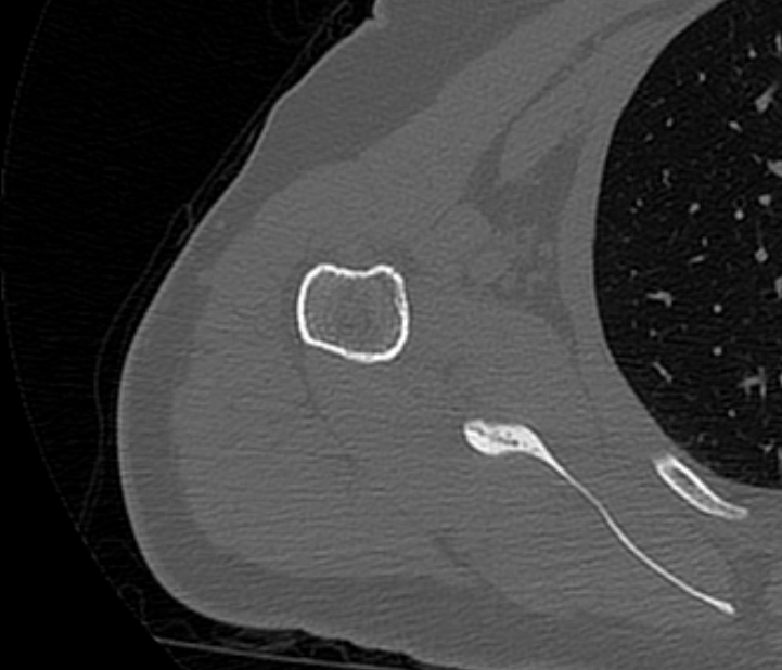 Avulsion fracture - greater tuberosity of humerus (Radiopaedia 71216-81514 Axial bone window 55).jpg