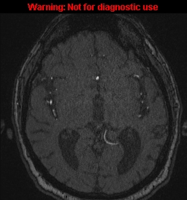 Azygos anterior cerebral artery (Radiopaedia 59325-66677 Axial MRA 84).jpg