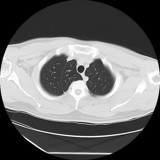 Azygos fissure (Radiopaedia 88181-104784 Axial lung window 7).jpg