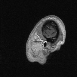 Balo concentric sclerosis (Radiopaedia 50458-55940 Sagittal T1 C+ 142).jpg