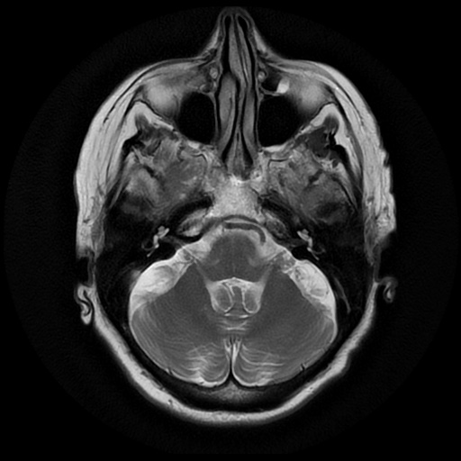 File:Balo concentric sclerosis (Radiopaedia 53875-59982 Axial T2 6).jpg