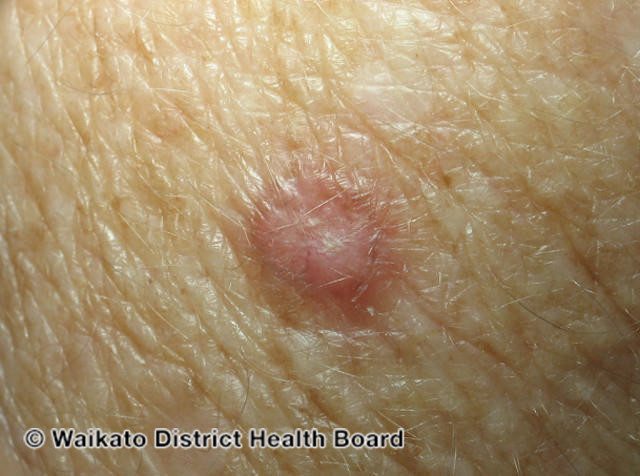 File:Basal cell carcinoma affecting the arms and legs 3 macro (DermNet NZ bcc-3-macro).jpg