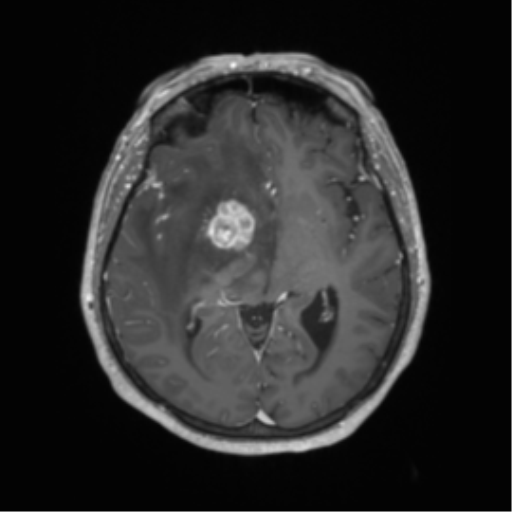 Basal ganglia metastasis (Radiopaedia 78928-91828 Axial T1 C+ 33).png