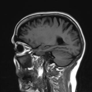 File:Base of skull chondrosarcoma (Radiopaedia 30410-31070 Sagittal T1 6).jpg