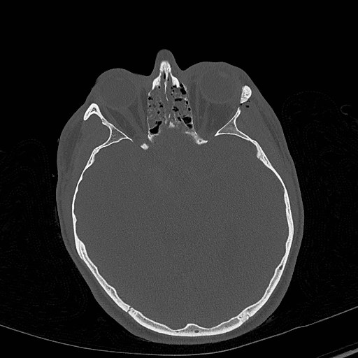 Base of skull fracture with bilateral Le Fort fractures (Radiopaedia 47094-51638 Axial bone window 42).jpg