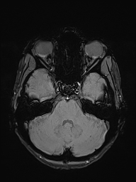 File:Basilar artery perforator aneurysm (Radiopaedia 82455-97733 Axial SWI 14).jpg