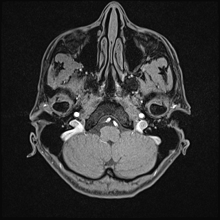Basilar artery perforator aneurysm (Radiopaedia 82455-97733 Axial T1 fat sat 19).jpg