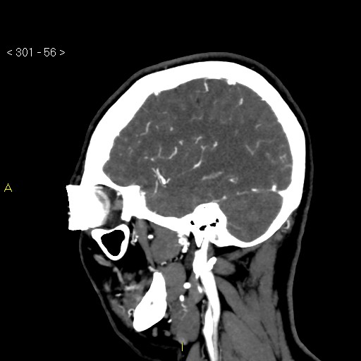 File:Basilar artery thrombosis (Radiopaedia 16260-15944 C 50).jpg