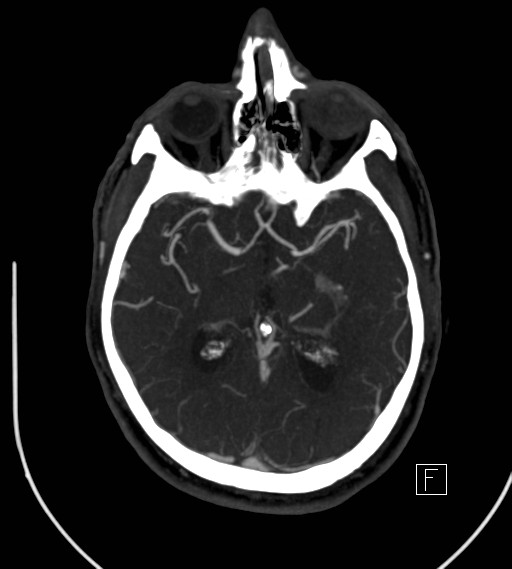 File:Basilar artery thrombosis (Radiopaedia 26986-27163 A 44).jpg