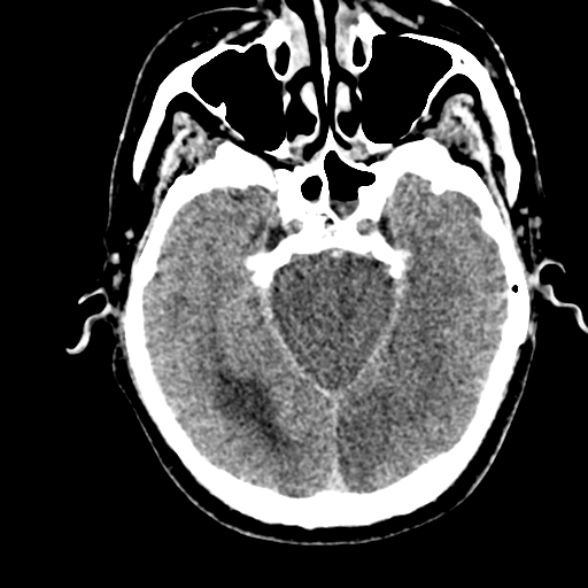 Basilar artery thrombosis (Radiopaedia 53351-59352 Axial non-contrast 44).jpg