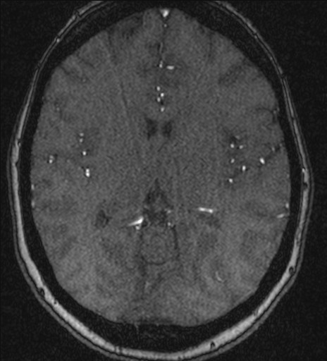 Basilar tip aneurysm (Radiopaedia 26504-26632 MRA 130).jpg