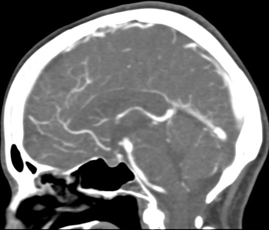 Basilar tip aneurysm with coiling (Radiopaedia 53912-60086 C 66).jpg