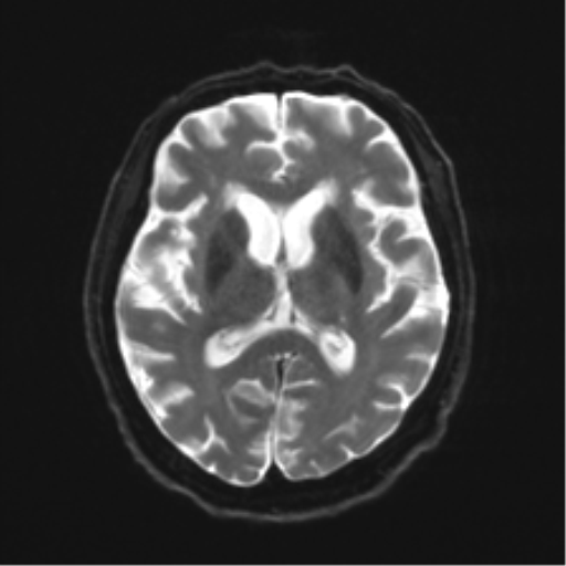 File:Behavioral variant frontotemporal dementia and late onset schizophrenia (Radiopaedia 52197-58083 Axial DTI Trace W 14).png