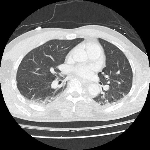 Benign post-traumatic pseudopneumoperitoneum (Radiopaedia 71199-81495 Axial lung window 39).jpg