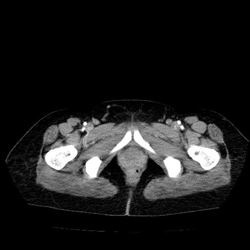 File:Benign spindle cell tumor - abdominopelvic (Radiopaedia 61300-69212 A 61).jpg